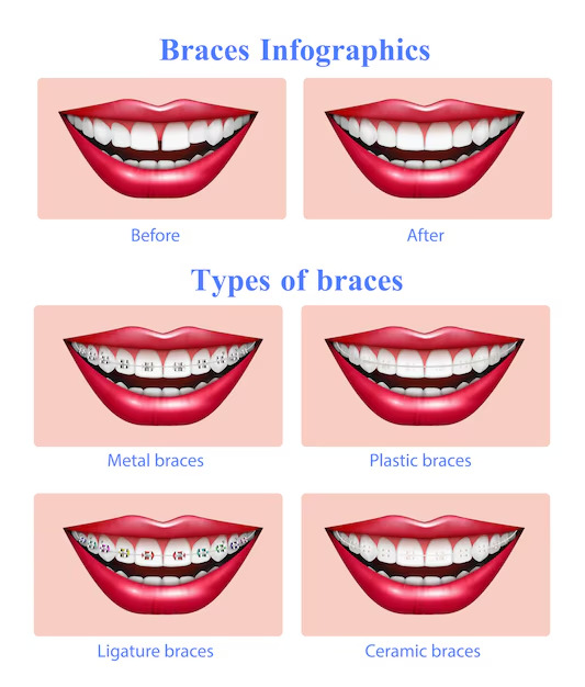 Types of Braces Used in Orthodontics