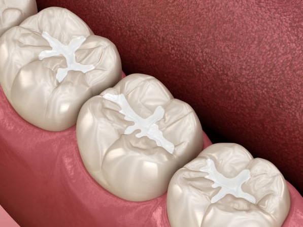 What is Dental Sealant? TotalDentalcaretips.com