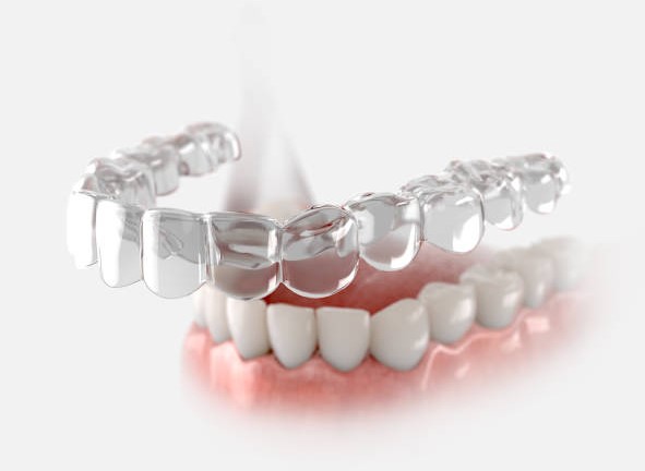 What is a mouthgaurd - Total Dental Care Tips